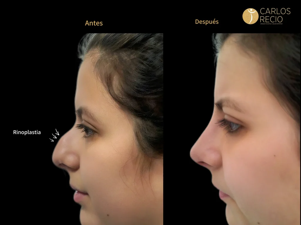 Rinoplastia funcional: cuándo la cirugía corrige problemas respiratorios RINOPLASTIA